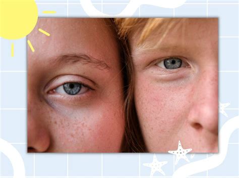 All You Need To Know About Sun Spots And Freckles Popxo