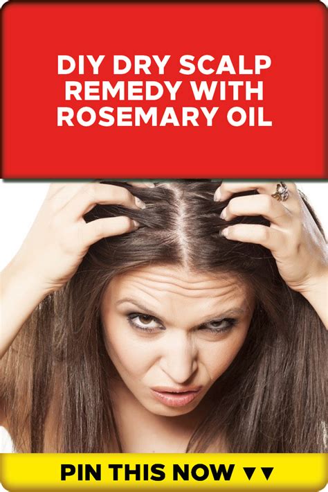 Diy Dry Scalp Remedy With Rosemary Oil Dry Scalp Remedy Dry Scalp