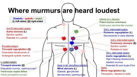 Where Murmurs Are Heard Loudest 2nd L Intercostal Space Pulmonary