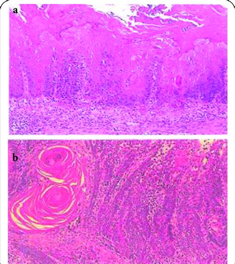 The Histology Of Tongue A Squamous Cell Carcinoma In Situ And B