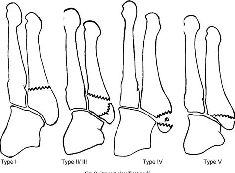 Figure 8 From Fractures Of The Fifth Metatarsal Diagnosis And Treatment Semantic Scholar