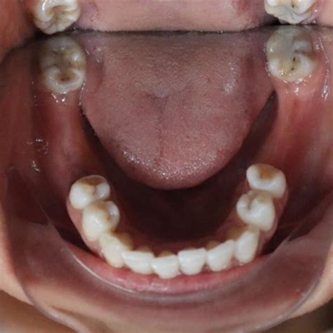 Pre Op Intraoral View Of Partially Edentulous Mandible Download