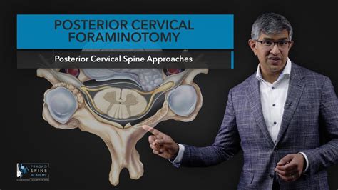 Posterior Cervical Foraminotomy Youtube
