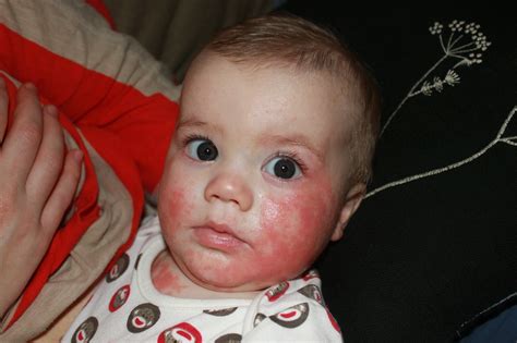 Why Do So Many Babies Have Eczema