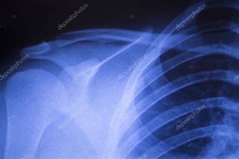 Shoulder Joint Orthopedic Xray Scan Stock Photo By ©edwardolive 117541732