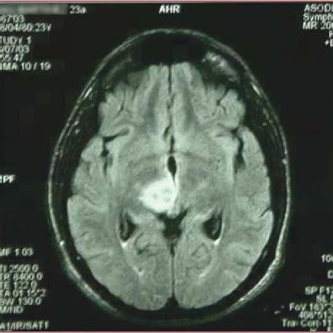 brain mri with gadolinium intravenous contrast showing a parenchymal download scientific