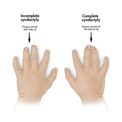 Syndactyly Hand Orthobullets