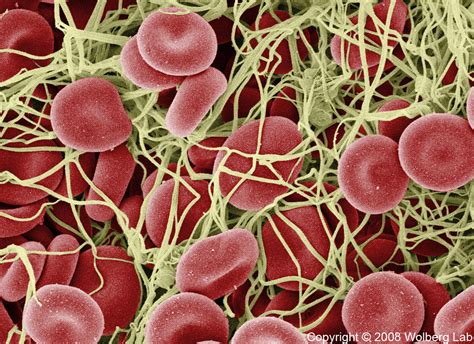 Scanning Electron Micrograph Of A Whole Blood Clot Wolberg Lab