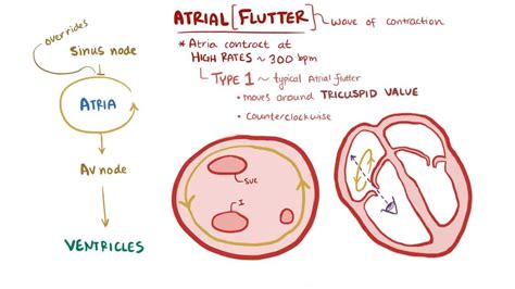 Atrial Fibrillation And Atrial Flutter Afib Explained Vrogue Co