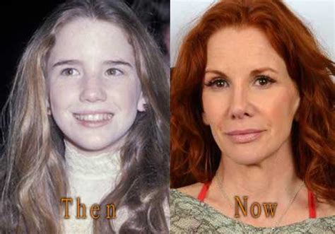 Top Celebrity Surgery Page Of Celebrity Plastic Surgery News Before And After Pictures