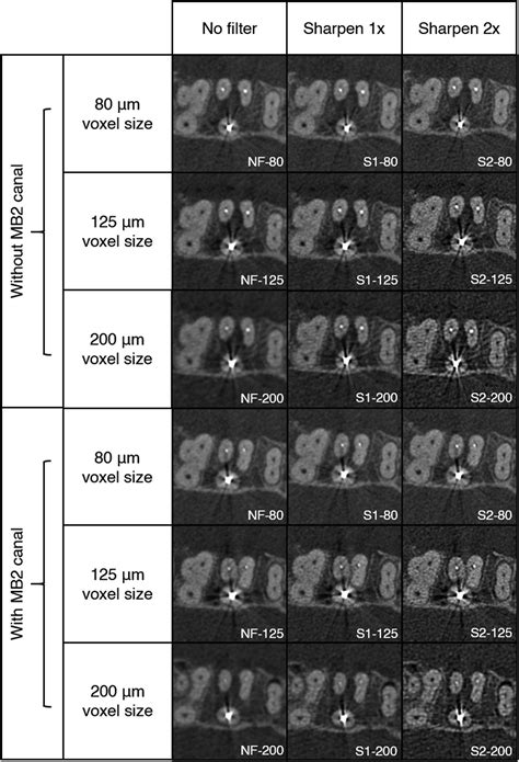 Influence Of Voxel Size And Filter Application In Detecting Second