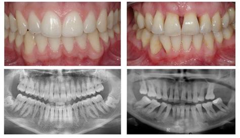 gum disease treament advanced dentistry