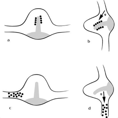 Position Of The Dix Hallpike Test To Evaluate The Left Posterior