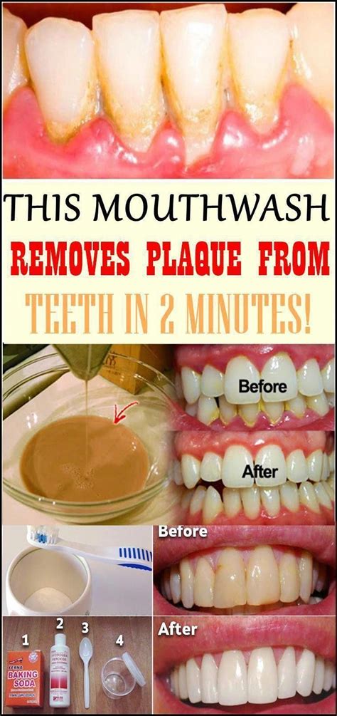 this mouthwash removes plaque from teeth in 2 minutes in 2020