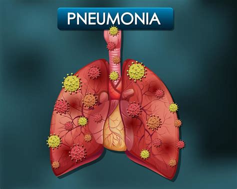 Pneumonia Poster With Human Lungs And Virus Cells 1142223