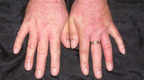 Skin Different Kinds Of Rash Staph Infection Causes And Symptoms