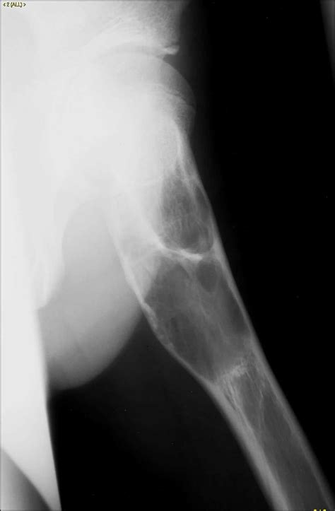 Unicameral Bone Cyst X Rays Case Studies Ctisus Ct Scanning