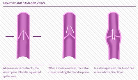 Overview And Symptoms Of Varicose Veins • The Vein Centre Auckland