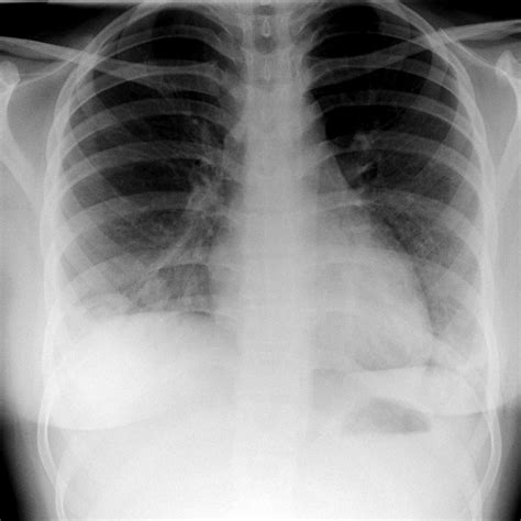 Granulomatosis With Polyangiitis Chest X Ray Wikidoc