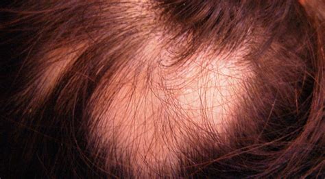 Dark Hair Rinse Patches Of Hair Loss