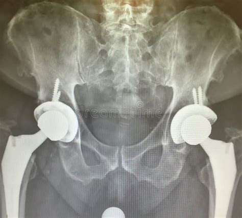 Total Hip Arthroplasty Good Quality Show Post Operation At Hip Stock