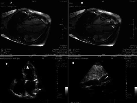 A B Mri Findings Supported The Biventricular Apical Akinesis Arrows