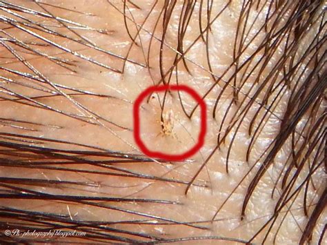 Head Lice Pictures Nature Cultural And Travel Photography Blog