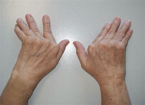 Study Medical Photos A 68 Year Old Woman With Rheumatoid Arthritis