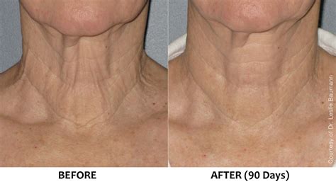 Ultherapy Non Surgical Neck Lift Loose Sagging Skin Neck