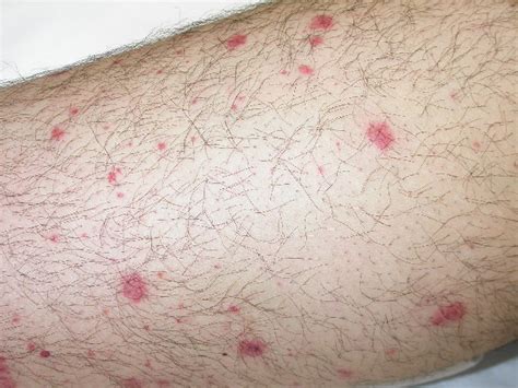 Causes Of Petechial Rash In Adults Prioritymaps