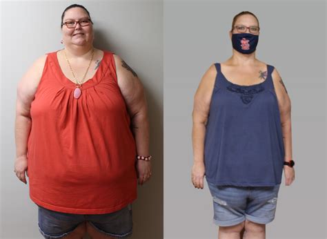 Amandas Weight Loss Tranformation St Louis Bariatrics