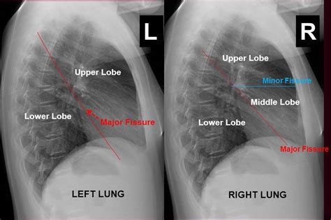 Lateral Chest X Ray Positioning