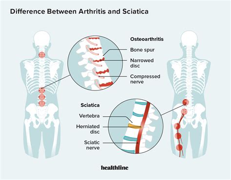 Arthritis And Sciatica How They Differ Causes Symptoms More