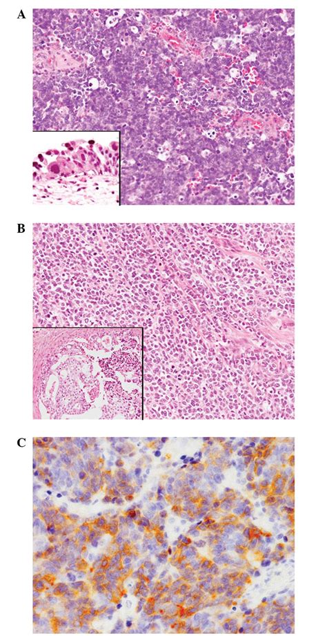 Small cell carcinoma of the urinary bladder and prostate ...