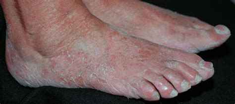 Fungal Infections Of The Skin Hair And Nails Fitzpatricks Color