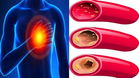 9 Ways You Can Clear Your Clogged Arteries Naturally Youtube