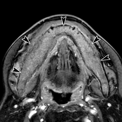 Imaging Of Malignant Minor Salivary Gland Tumors Of The Head And Neck