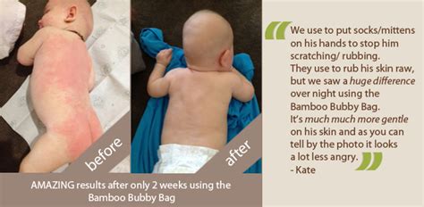 Bamboo Bubby Bag Benefits For Babies With Eczema