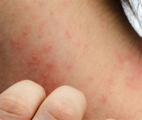 The 6 Most Common Types Of Eczema And How To Treat Home Remedies