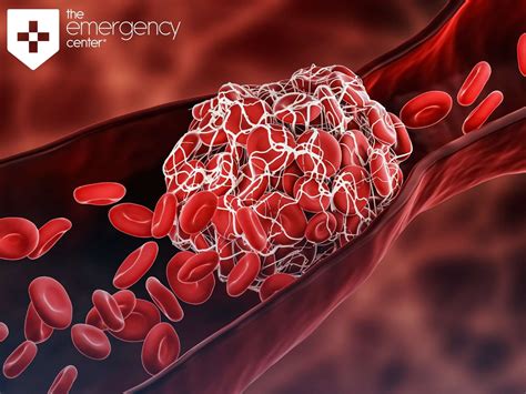 When Blood Clots Become An Emergency The Emergency Center