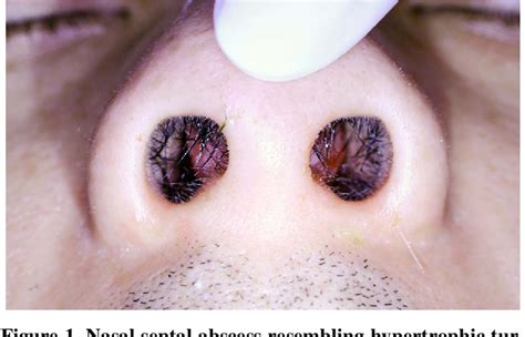 Figure From Spontaneous Nasal Septal Abscess Presenting As Complete Nasal Obstruction