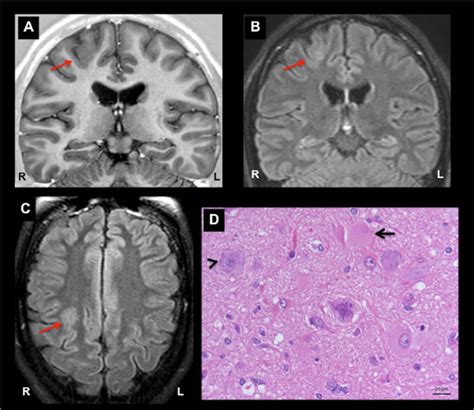 Mri And Histology In Focal Cortical Dysplasia Type Iib Mri Images A