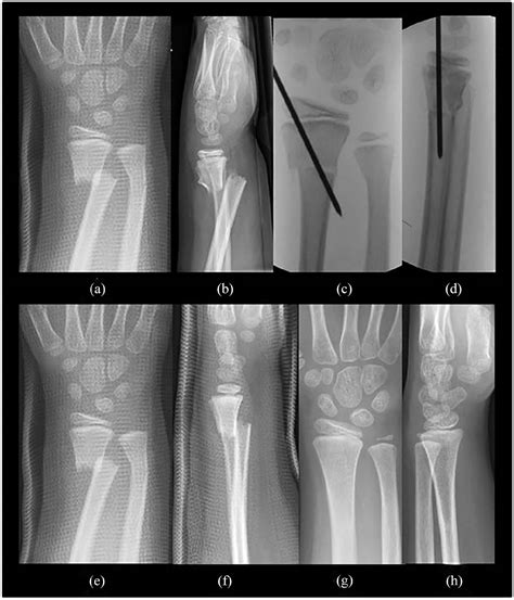 Treatment Of Distal Forearm Fractures In Children J J Sinikumpu Y