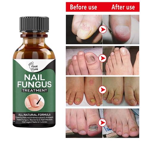 10ML Nail Fungus Removal Cream Onychomycosis Fungal Nail Treatment