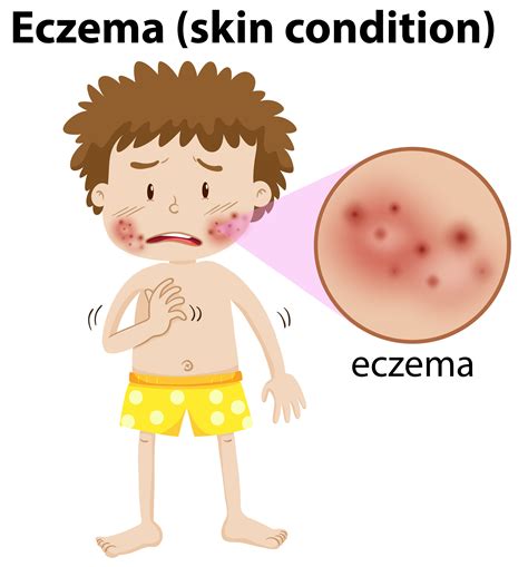 Eczema Is A Disease Affecting Approx 316 Million And At Least 178