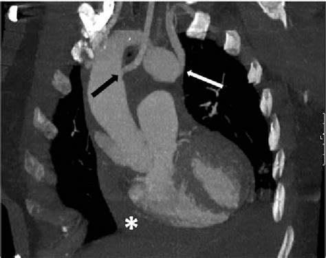Figure 1 From Right Aortic Arch And Kommerells Diverticulum Associated