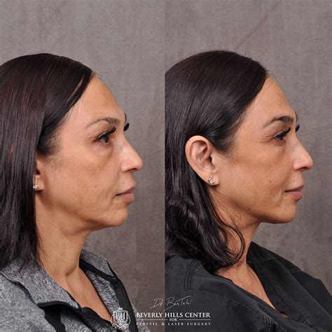 Laser Facelift Profound Microlift Before And Afters Beverly Hills