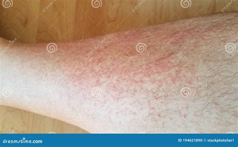 Red Rash Or Inflammation On Male Leg Stock Photo Image Of Itchy