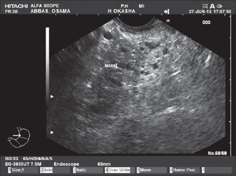 A Pancreatic Serous Cystadenoma Giving A Honey Comb App Open I