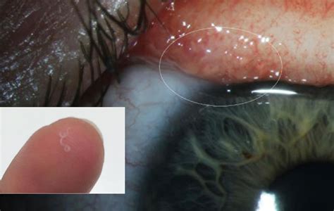 Woman Discovers 14 Parasitic Worms In Her Eye Insight